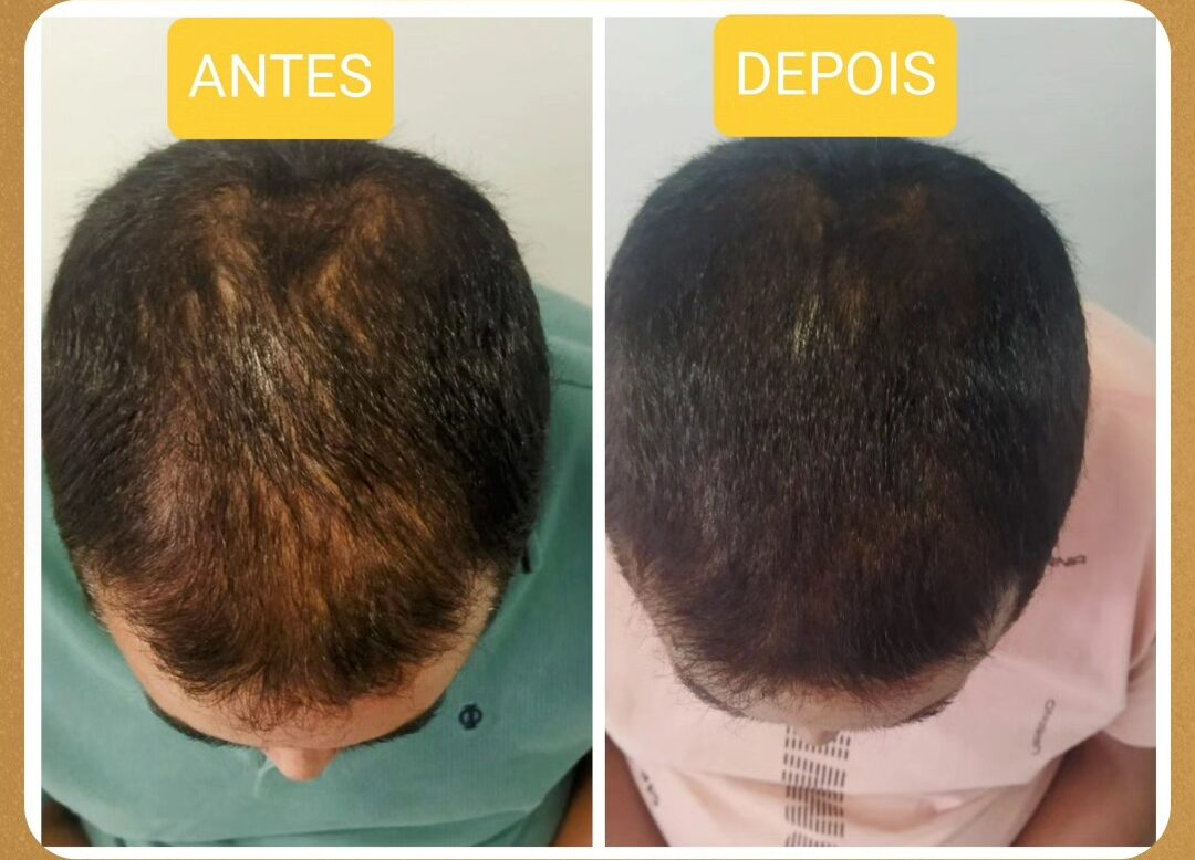 Tratamento para Calvície em Curitiba | Cássia Marconi Tratamento para Calvície em Curitiba | Cássia Marconi